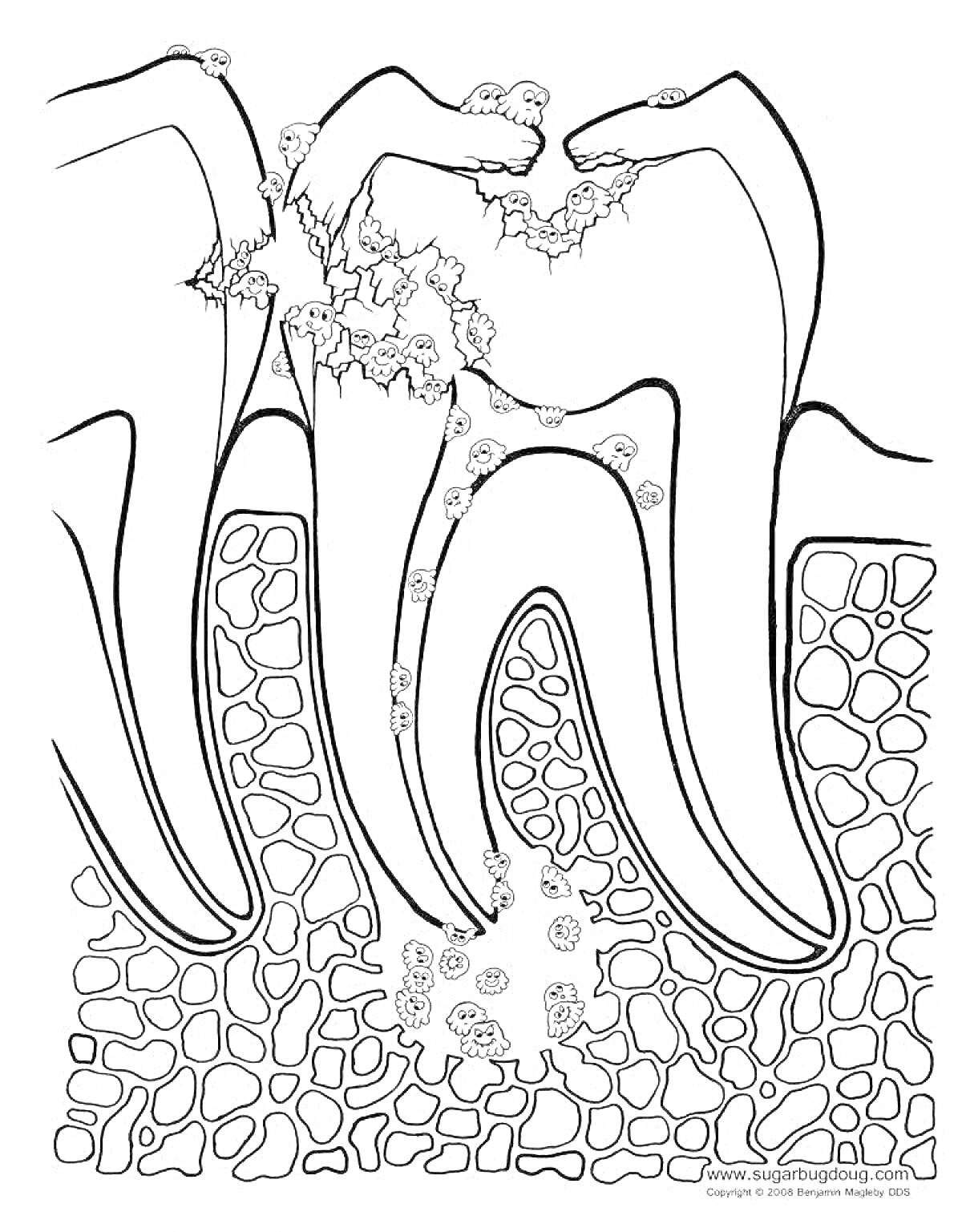 Раскраска Зубной кариес: разрушение зубной эмали