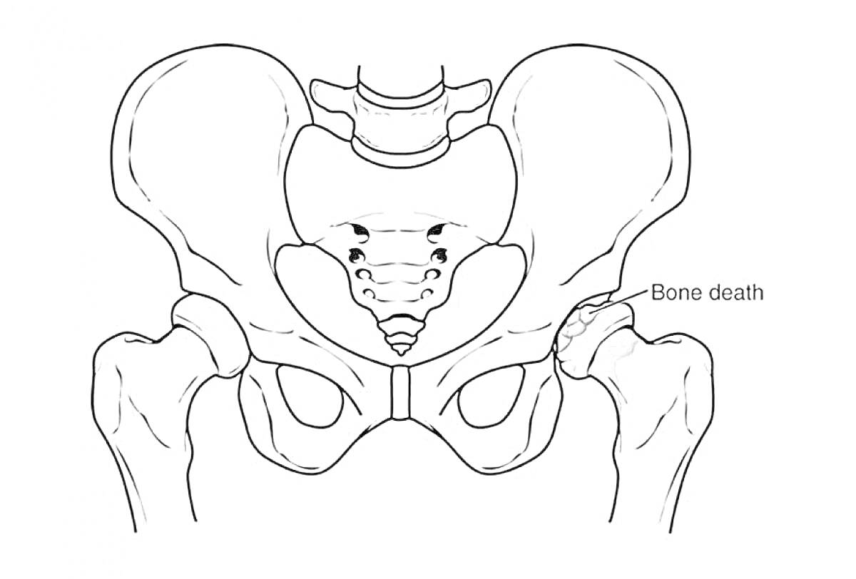 Раскраска Изображение человеческого тазобедренного сустава с указанием некроза кости