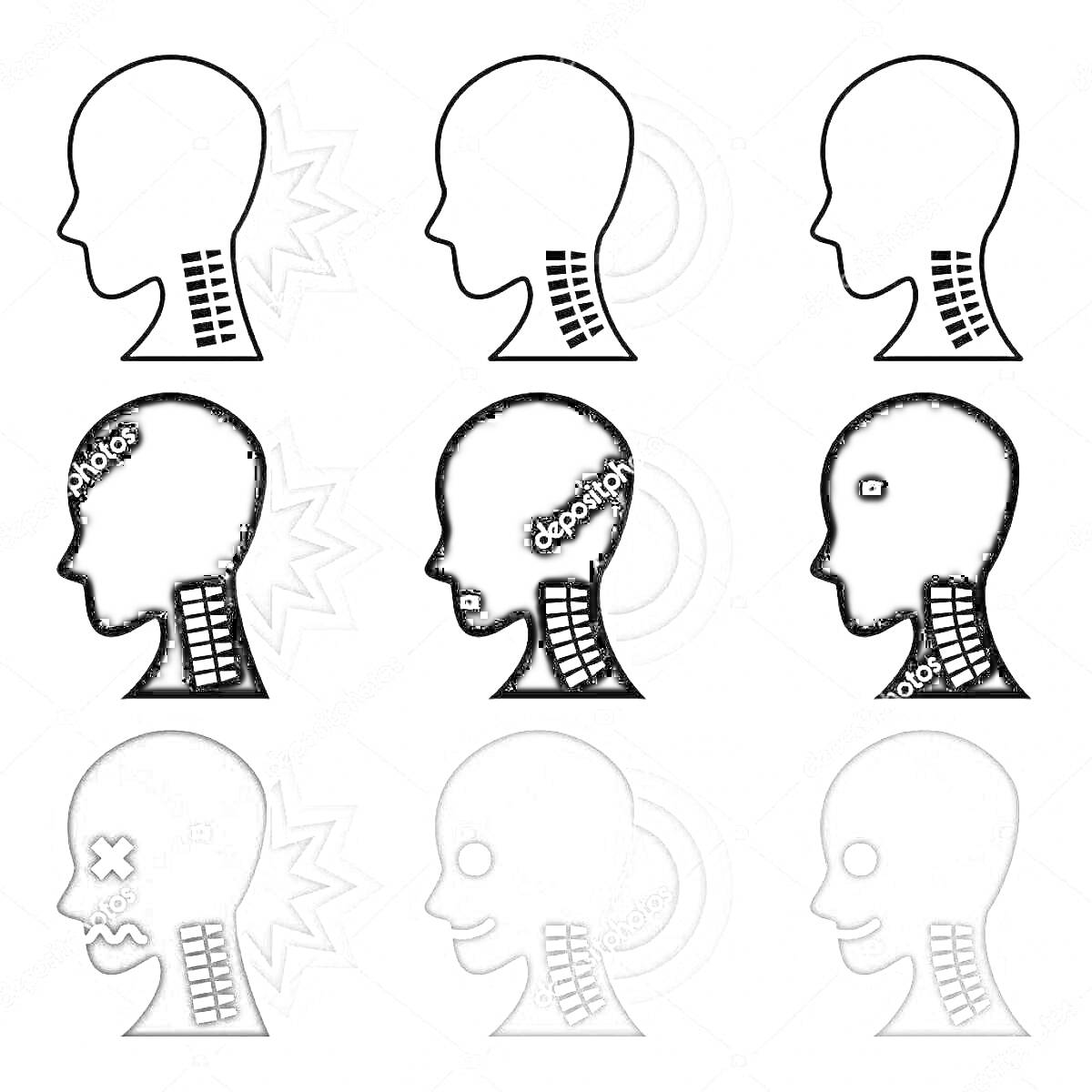 Схематические изображения головы с акцентом на шею и позвоночник, различные состояния и степени проблем