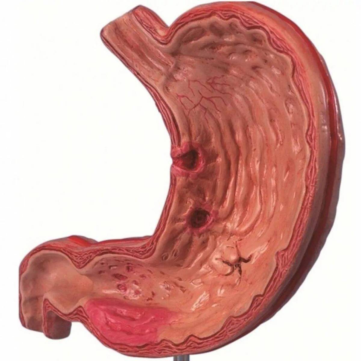 Тотальный желудка. Острый эрозивный гастрит макропрепарат. Хронический гастродуоденит.